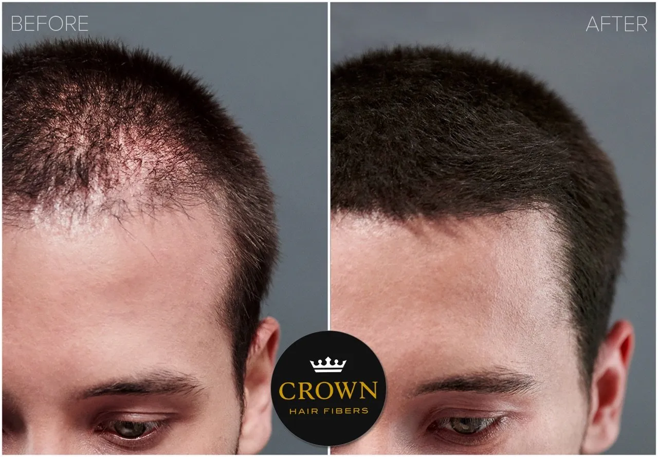 CROWN Hair Building Fibers (28g) - Instantly Cover Fine & Thinning Hair for a Thicker, Fuller Look - A Natural Keratin Concealer - 13 Shades for Men & Women - Dark Brown