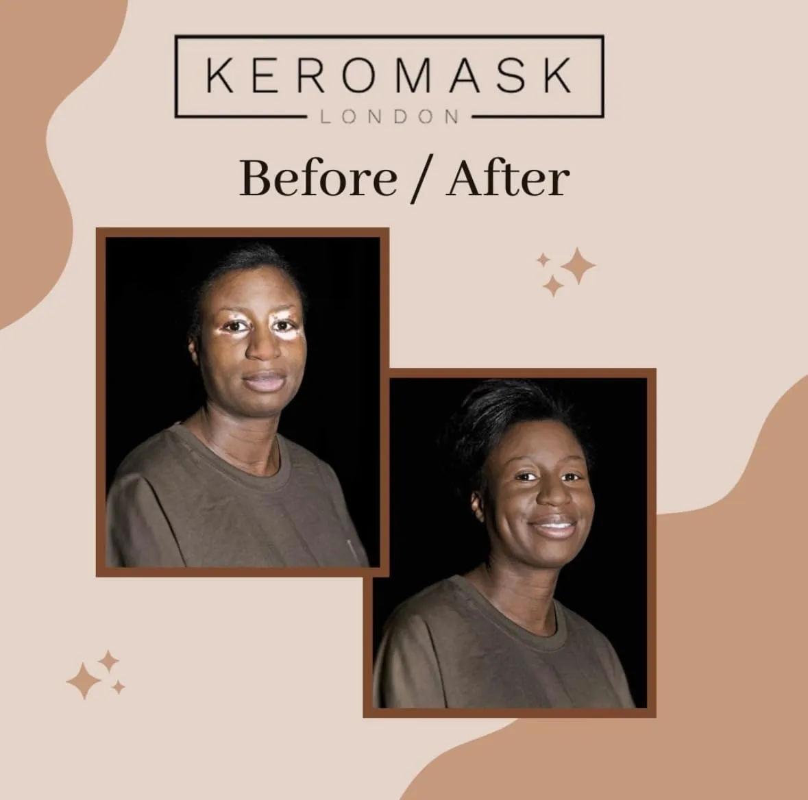 Keromask Full Coverage Concealer | Camouflage Makeup | Waterproof Concealer | Hypoallergenic | Vitiligo, Tattoo, Rosacea, Tattoo Cover | 24 Shades | Light No 3