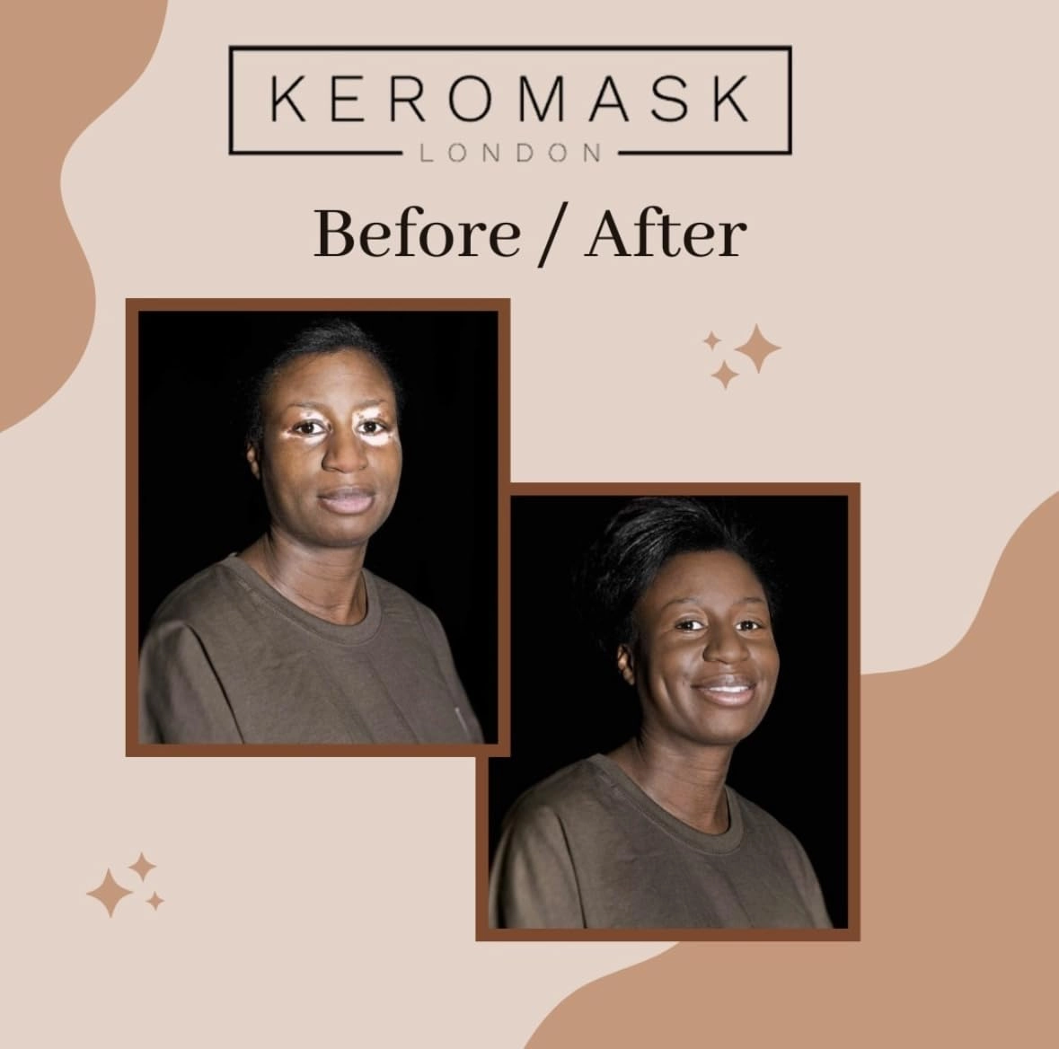 Keromask Full Coverage Concealer | Yellow Mixer | Camouflage Makeup | Waterproof Concealer | Hypoallergenic | Vitiligo, Tattoo, Rosacea, Tattoo Cover |24 Shades