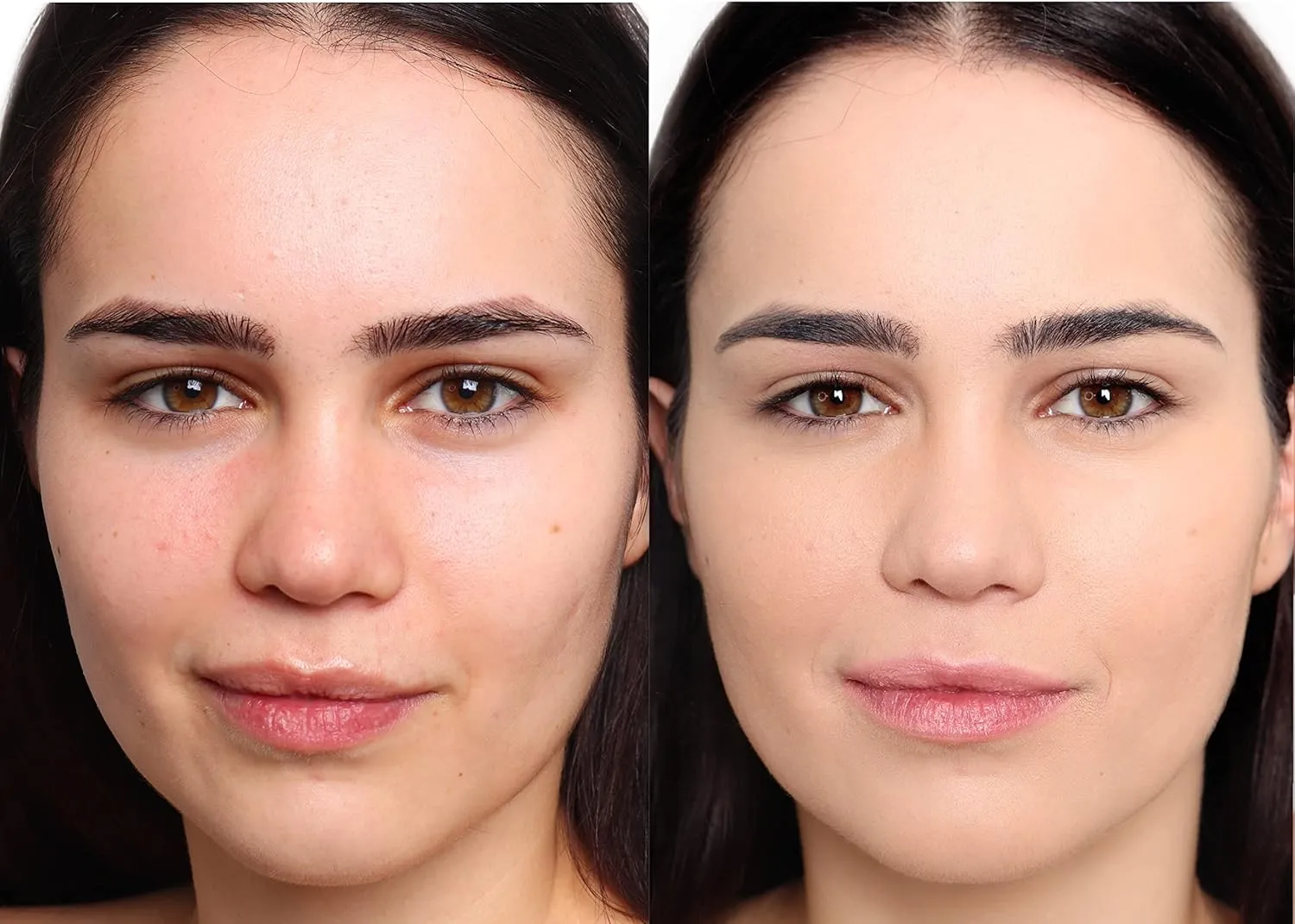 Loves-You-Back 3in1 Mineral Powder Foundation (BEIGE 2) | Designed for Rosacea, Acne-Prone, Sensitive Skin | 3IN1 - Concealer, Powder and Foundation | Natural   Lightweight Coverage